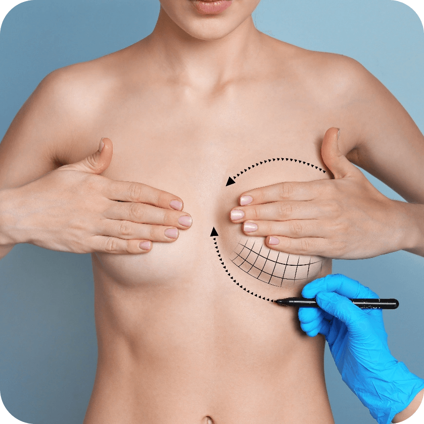Lipofilling du sein