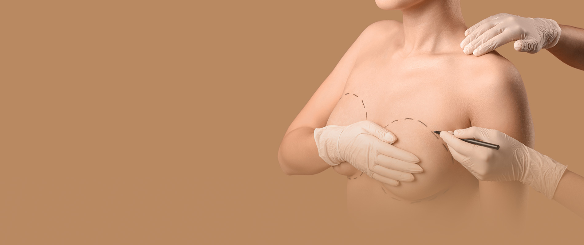 Augmentation mammaire par lipofilling